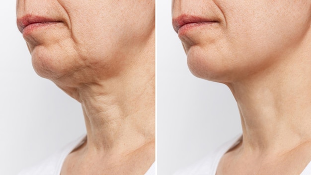 Parte inferior do rosto e pescoço de uma mulher idosa com sinais de envelhecimento da pele antes e depois do lifting facial