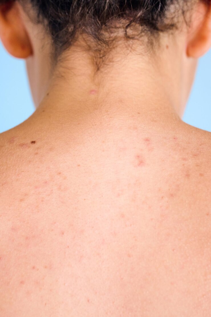 Foto parte traseira de uma adolescente com acne na pele