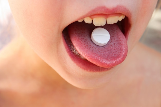 Pastilla blanca en la lengua del niño