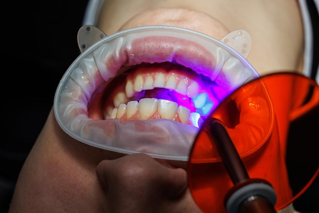 Patient mit offenem Mund, der im Zahnarztstuhl liegt, während der Zahnarzt ein zahnärztliches Instrument hält. Zahnbehandlung in einer modernen Zahnklinik. selektiver Fokus