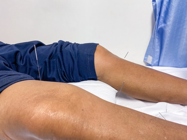 Foto patienten, die sich einer akupunktur am körper im hostipal und in der klinik unterziehen