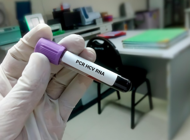 PCR-HCV-RNA-Test zur Diagnose einer Hepatitis-C-Virusinfektion