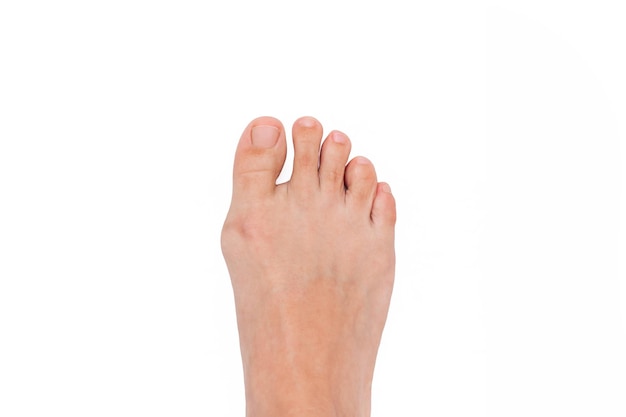 Pé de uma mulher com deformidade de hálux valgo do dedão do pé causada pelo uso de sapatos desconfortáveis