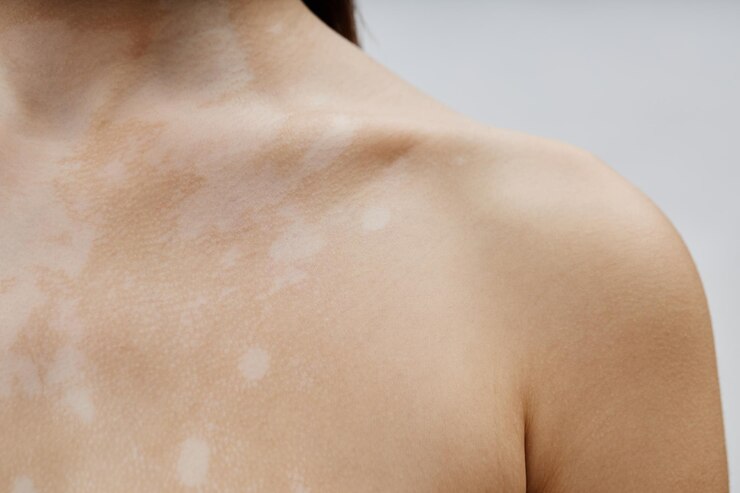 Foto pele com manchas brancas na clavícula de uma jovem com vitiligo no estúdio