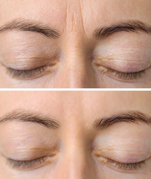 Foto pele do rosto da mulher antes e depois de procedimentos cosméticos de beleza estética com rugas da pele removidas