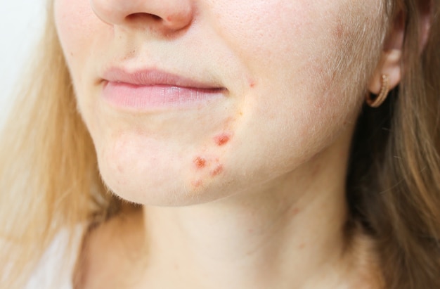 Pele oleosa de mulher com problemas de acne. Cicatrizes e feridas no rosto. Foto de cuidados de saúde.