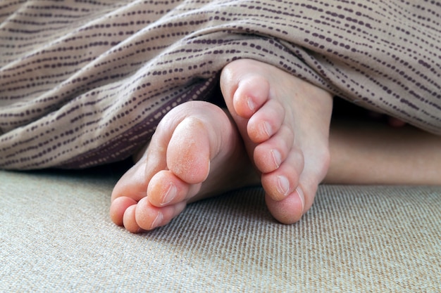 Pele seca e rachada dos pés da mulher na cama. tratamento de pés.