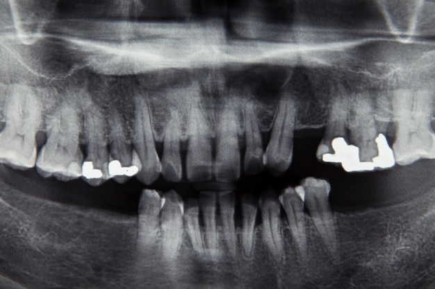 Película dental de rayos x para el concepto de cuidado dental