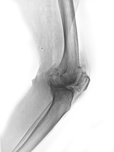 película de radiografía AP anterior posterior de la rodilla muestra un espacio articular estrecho