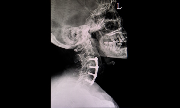 Película de rayos X del cuello de un paciente con fijaciones de placa y tornillos