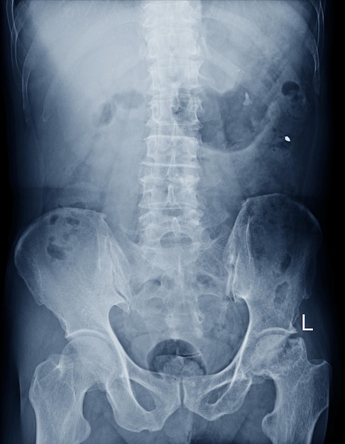 Película de rayos x LS columna AP. vistas que muestran el cuerpo vertebral L1 fractura por compresión. Concepto de imagen médica.