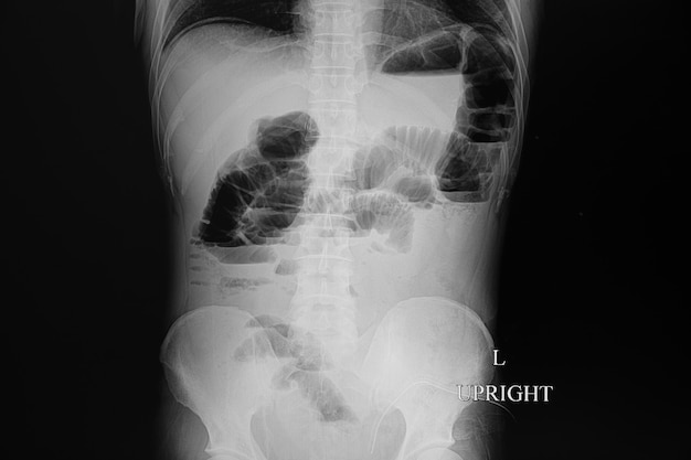 Película de rayos X de un paciente con obstrucción intestinal.