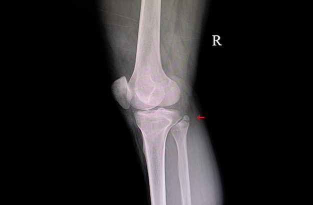 Foto película de rayos x que muestra fractura de peroné proximal