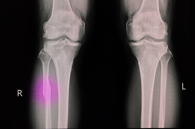 Película de rayos X de una rodilla de un paciente con fractura de peroné proximal fractura del hueso de la pierna