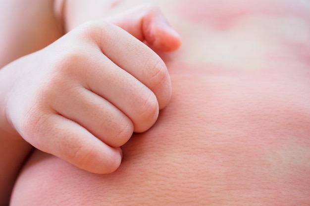 Pequeña niña asiática rasguño de la mano en su cuerpo con erupción cutánea con picazón y alergia