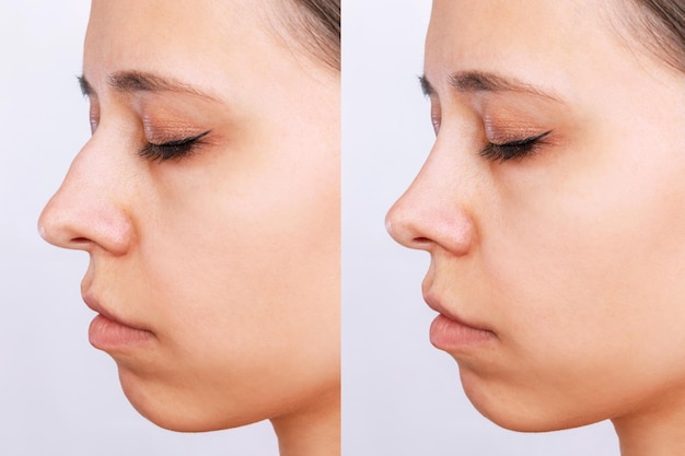 Un perfil de la cara de la mujer con la nariz antes y después de la rinoplastia aislada en un fondo blanco