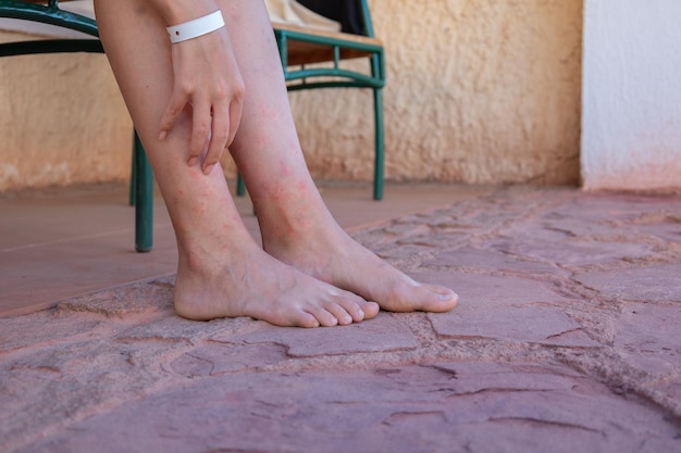 Pernas de menina mordidas por mosquitos closeup Mulher coçando os pés mordidos por insetos