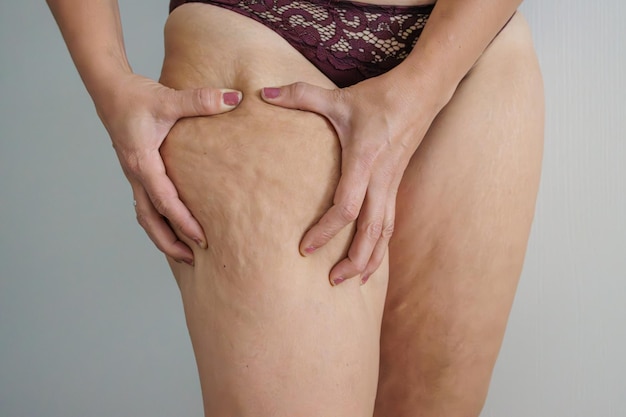 Foto pernas de mulher branca com flacidez e celulite