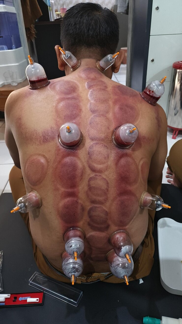 las personas están en terapia de ventosas