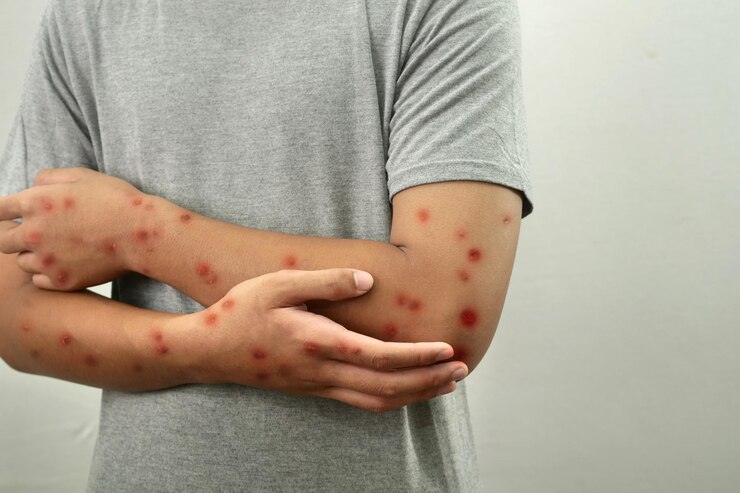 Foto pessoa anônima com varíola de macaco epidemia de varíola do macaco