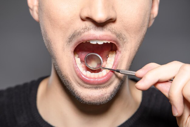 Pessoa com espelho na boca está verificando a parte de trás dos dentes da frente para ver se há cárie