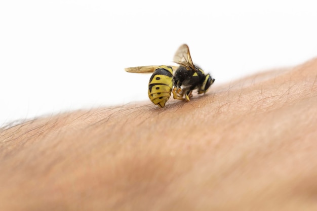 Picadura de abeja en la mano humana