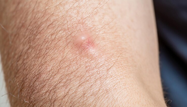 picadura de mosquito en el cuerpo humano