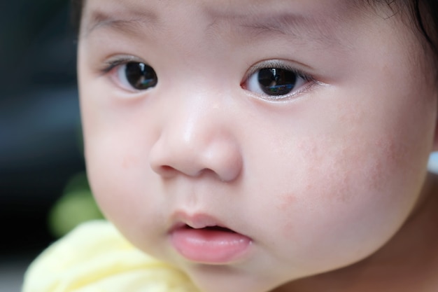 Piel alérgica bebé con mancha roja.