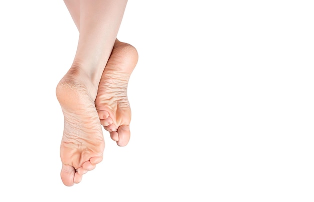 Foto piel áspera en las plantas de los pies talones secos piel seca y agrietada en los pies que requieren cuidado plantas de los pies secas y agrietadas piernas femeninas en una posición elegante aislada en el espacio de copia de fondo blanco