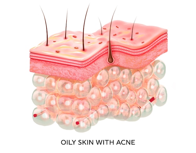 Foto piel grasa con acné ilustración 3d de la estructura de la microestructura de las capas de la piel