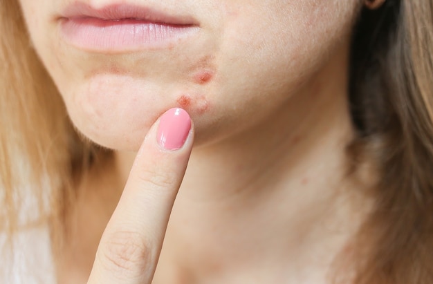 Piel grasa de mujer con problemas de acné. Cicatrices y heridas en la cara. Foto de atención médica.