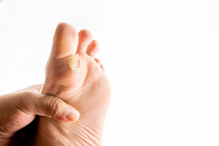 Piel seca, callo plantar y escamas en el pulgar sobre un fondo blanco Imagen para fines médicos