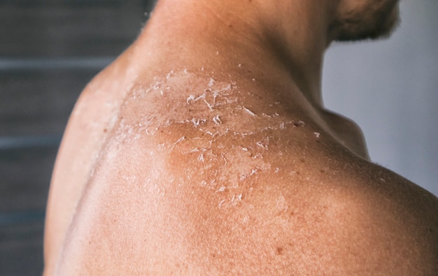 La piel seca y con picazón del hombre después de tomar el sol.