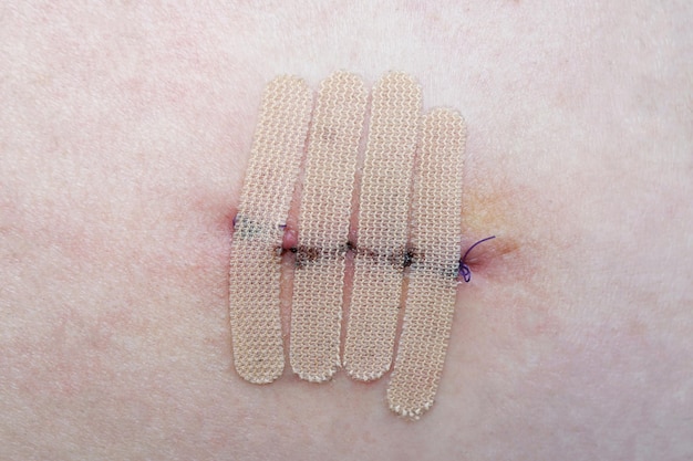 Piel con sutura y tiras de cierre de heridas o cinta quirúrgica