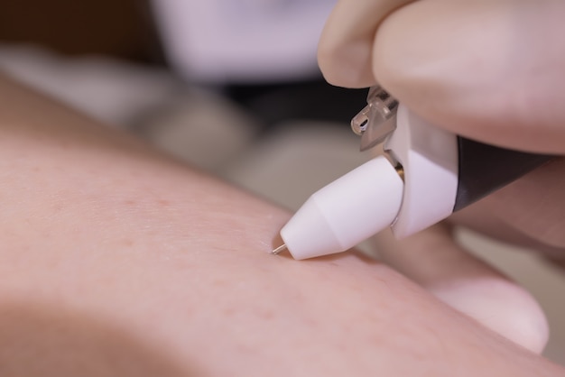 Piernas femeninas en hoja morada durante la depilación por una esteticista profesional con guantes. Spa, industria de la belleza, tratamiento en clínica, electrólisis.