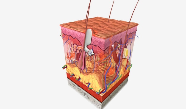 Pioderma Gangrenoso Etapa II 3d