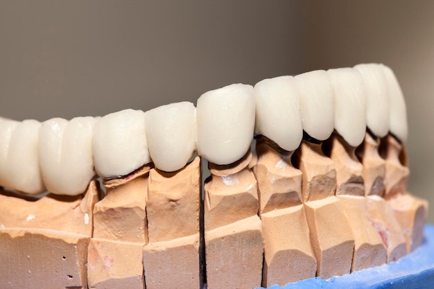 Placa de dente de porcelana de zircônio na foto da loja do dentista