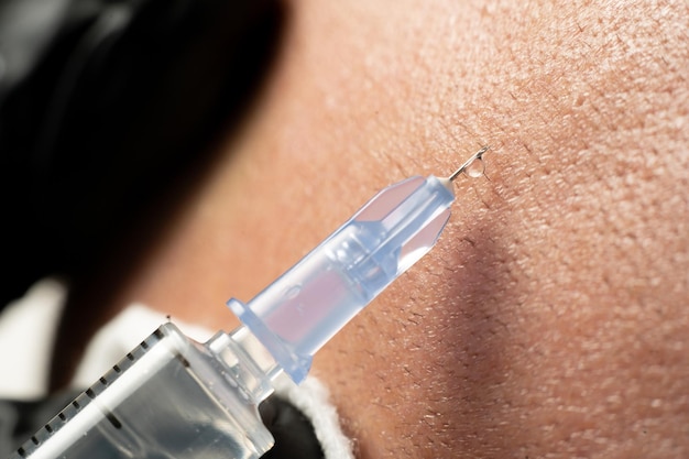 Plasmolifting tratamiento de calvicie con inyecciones de belleza de cerca hacer una inyección subcutánea en el punto calvo Plasmolipting de un paciente masculino