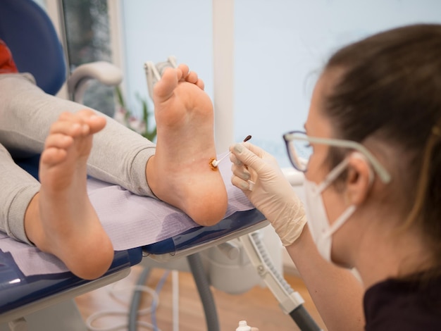 Foto podologin behandelt eine warze am fuß eines patienten