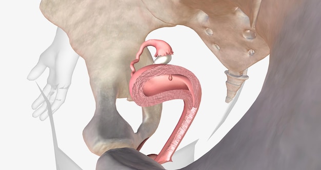 Foto los pólipos endometriales son crecimientos anormales del revestimiento interno del útero conocido como endometrio.