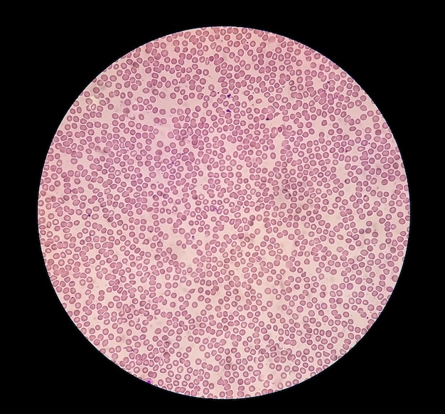 Portaobjetos hematológico bajo microscopía que muestra trombocitopenia. Nivel extremadamente bajo de recuento de plaquetas.
