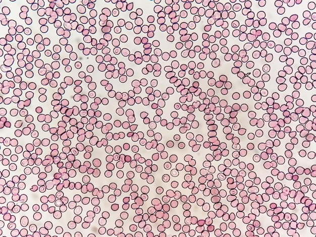 Portaobjetos hematológico bajo microscopía que muestra trombocitopenia. Nivel extremadamente bajo de recuento de plaquetas.