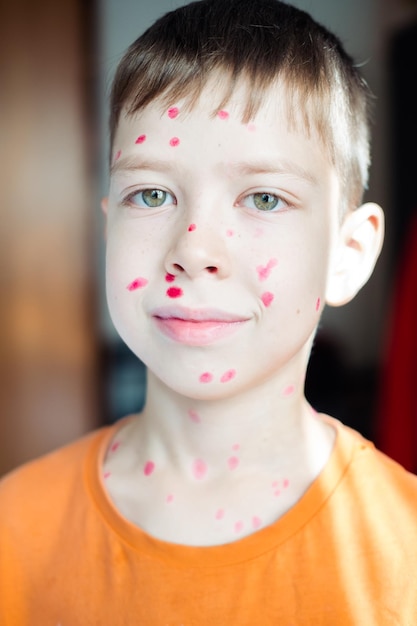 Porträt eines 10-jährigen Jungen mit Windpocken und einem mit Furacilin verschmierten Ausschlag im Gesicht