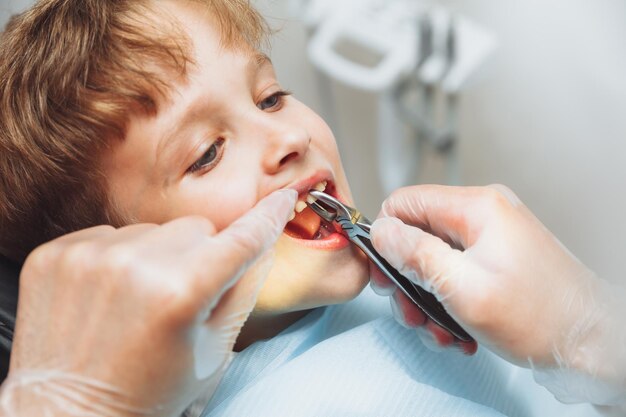 Porträt eines Kinderpatienten und die Hände eines Kinderzahnarztes mit Zahnzange Nahaufnahme schmerzlose Extraktion von Zähnen Kinderzahnheilkunde