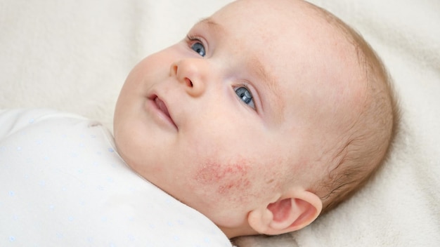 Foto porträt eines süßen kleinen babys mit roter haut, das an akne oder dermatitis leidet. konzept eines neugeborenen