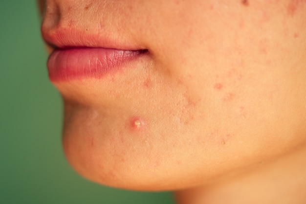 Pós-acne, cicatrizes e espinhas vermelhas purulentas no rosto de uma jovem. conceito de problemas de pele e falha harmônica.