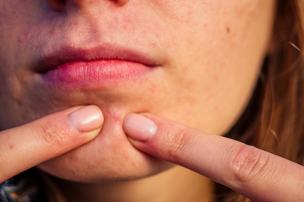 Post-acné, cicatrices y granos rojos en el rostro de una mujer joven. concepto de problemas de la piel.