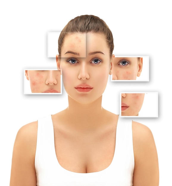 Post-Akne-Flecken Behandlung von Akne-Narben Entfernung von Akne-Narben