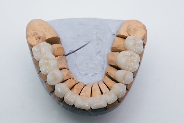 Prato dentário de porcelana zircônio em loja de dentista. ponte de cerâmica em modelo de gesso.