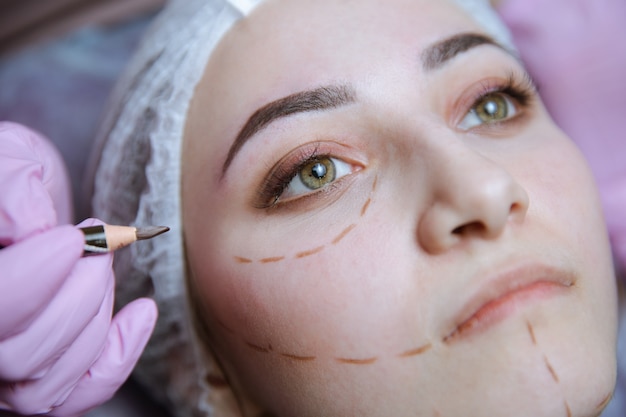 Preparación para cirugía plástica. Modelo joven en la clínica con líneas de perforación en el rostro.